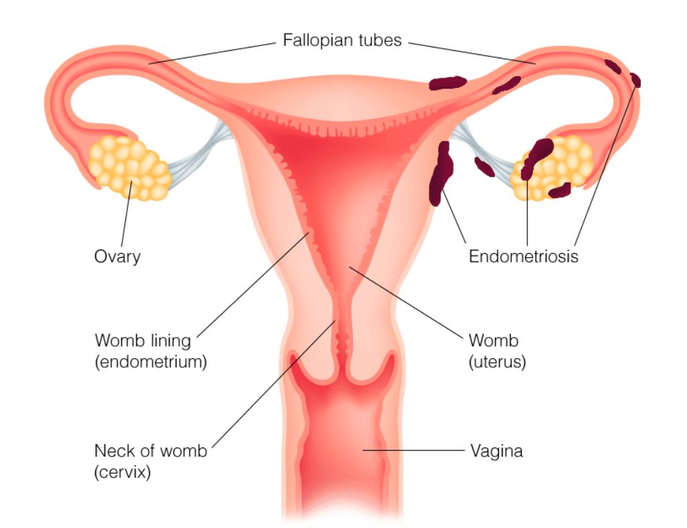 Endometriosis